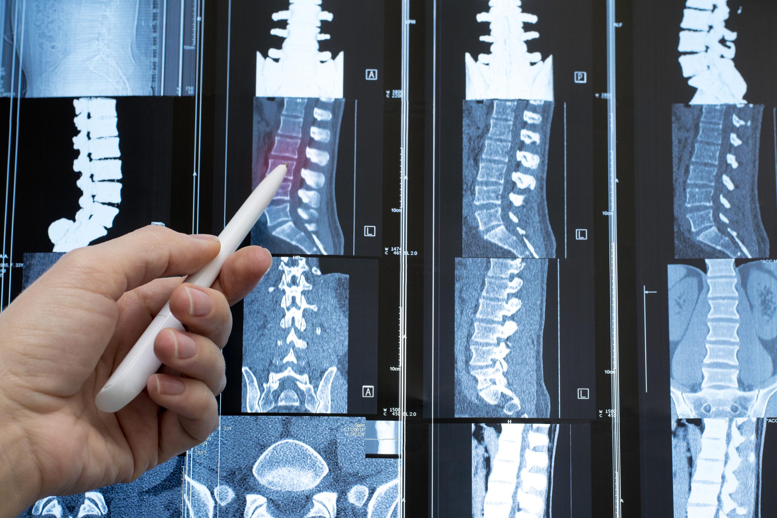 consenso manejo fractura vertebral osteoporótica España